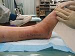 Tami's 'Franken Foot' 15 Days after Surgery in Denver - December 5, 2005