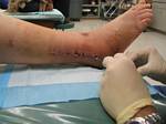 Removing Staples and Stiches from Tami's 'Franken Foot' 15 Days after Surgery in Denver - December 5, 2005