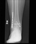 X-ray of Tami Wendell's Broken Ankle 6 Months after Surgery - 06-20-2006